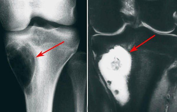 Abordan el osteosarcoma en la UANL 1 1 67