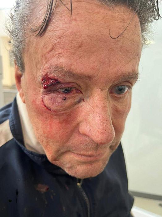 Alfredo Adame con posible desprendimiento de retina tras golpiza 1