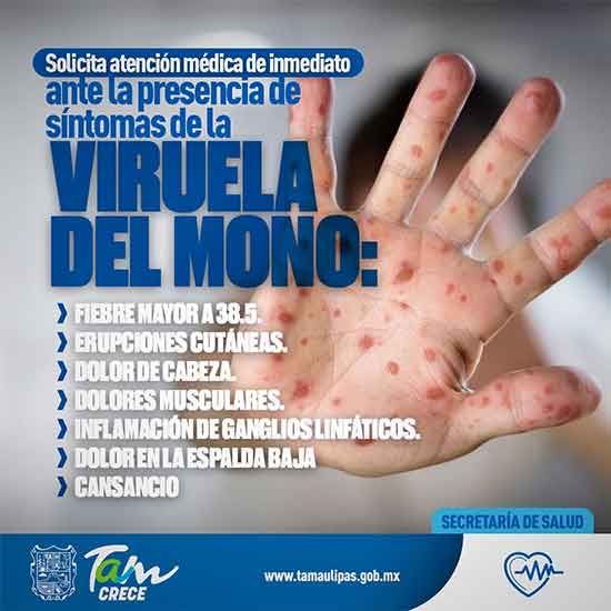 Alerta ante casos de viruela del mono: uno en Tampico y otro en Matamoros 1 VIRUELA MONO 2