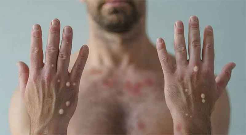 Debe usarse vacunación antiviruela del mono, si está disponible: Ssa 1 VIRUELA MONO