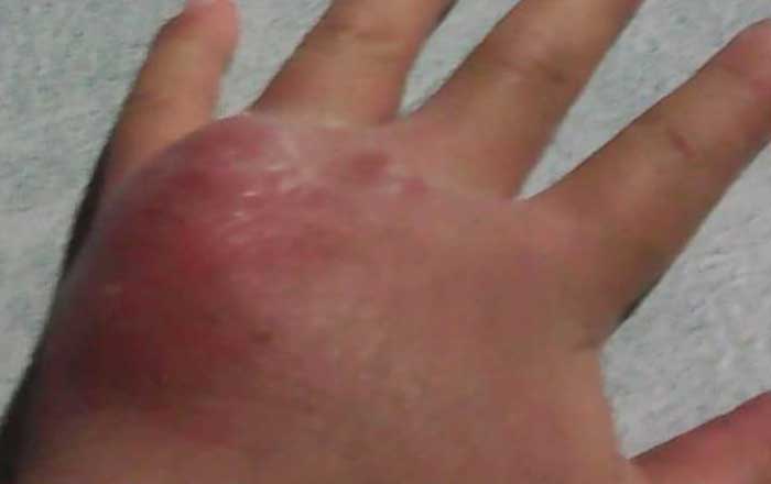 Trasladan a Monterrey a niño atacado por araña violinista 1 mano