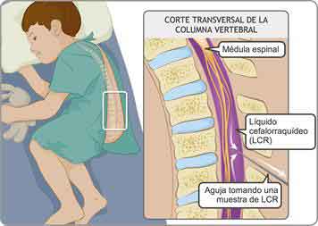 Fallece en Matamoros tercer paciente por brote de meningitis 1 MENINGITIS