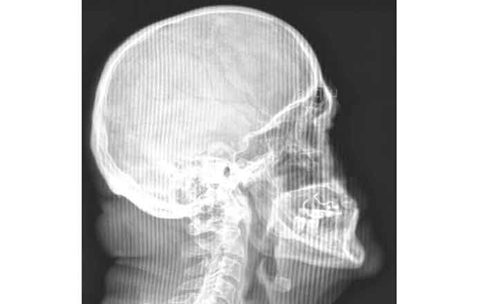 Ceguera nasal: ¿secuela del Covid? 1 RAYOS X