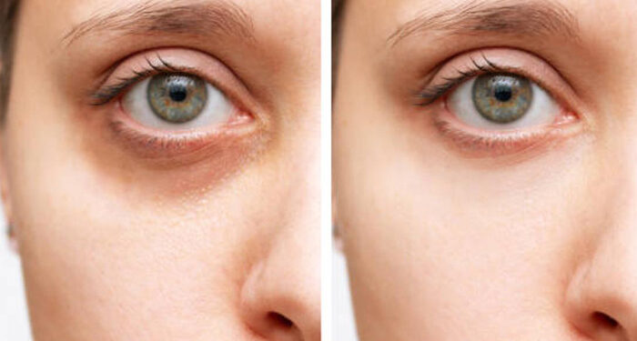 Remedios caseros para eliminar las ojeras al instante
