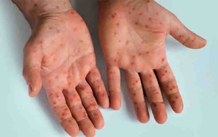 MPOX