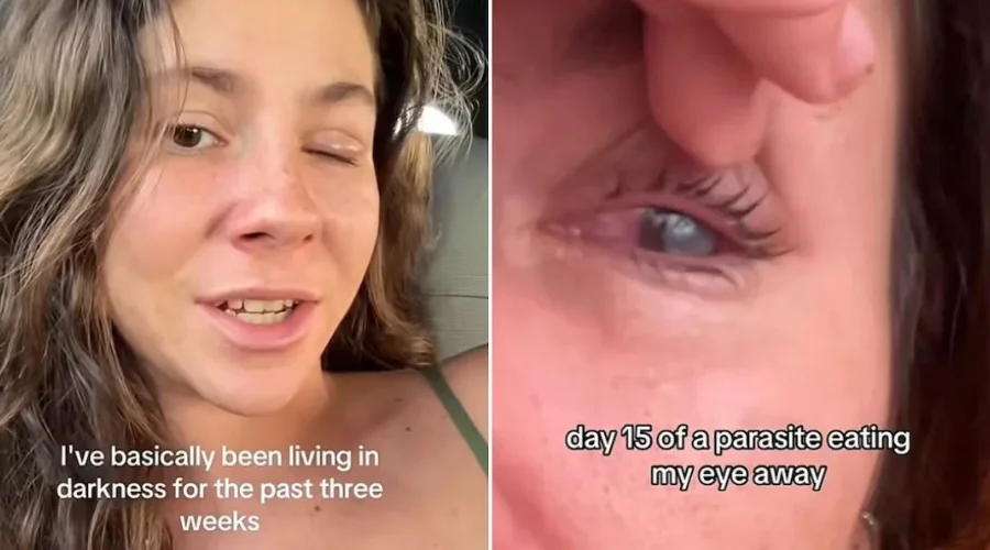 Parásito devora la córnea de ojo de mujer mientras vivía en México