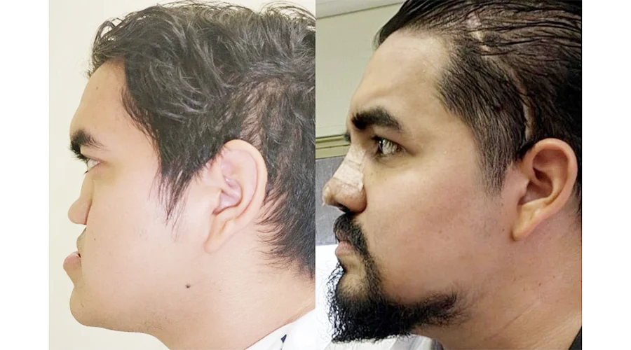 Especialistas del IMSS reconstruyen rostro de joven en NL 1 JOVEN NL 2bbb