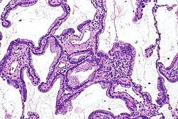 ¿Qué se sabe del adenocarcinoma pulmonar, el tipo de tumor que le extirparon al papa León XIV? 1 adenocarcinoma pulmonar